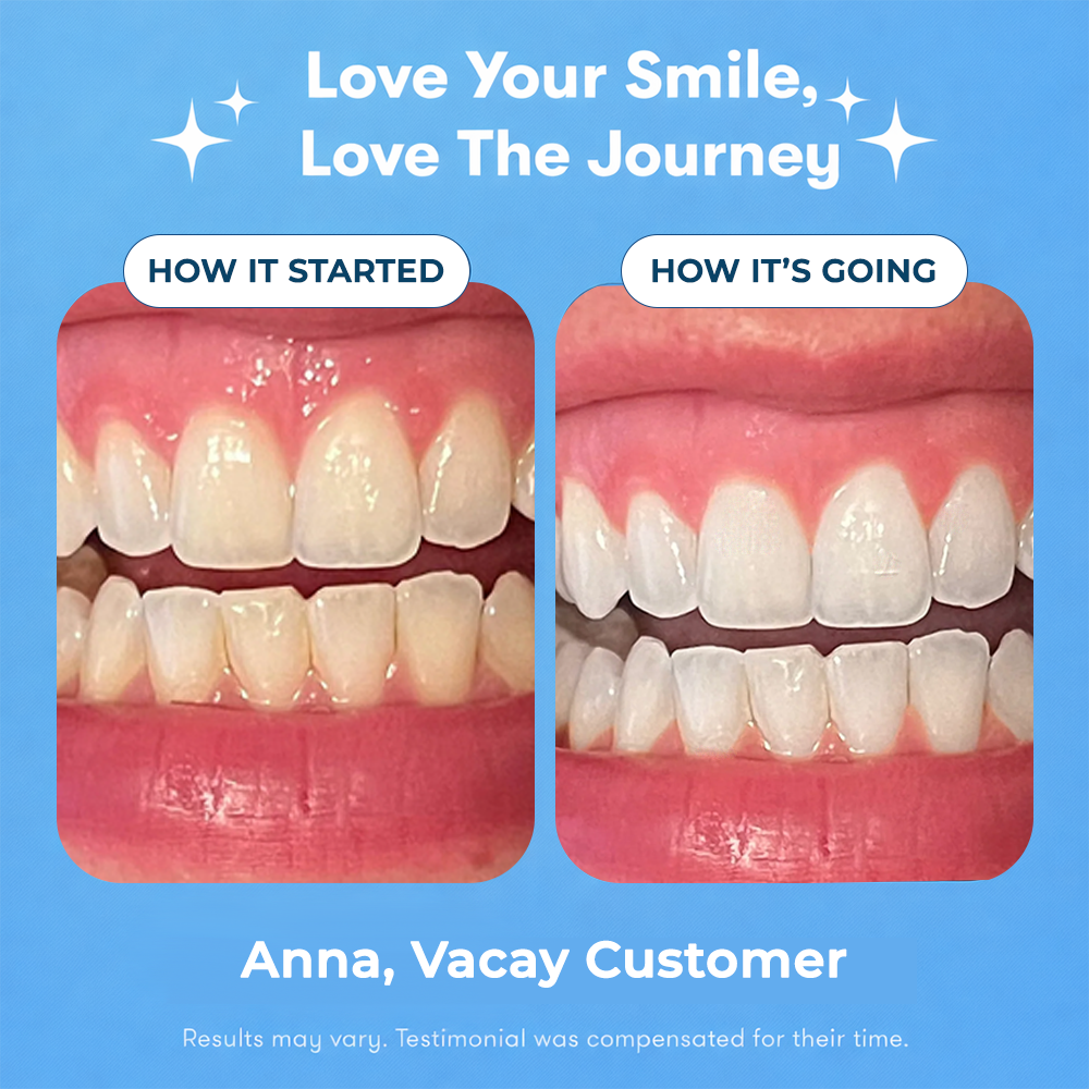 ShadeHold+™ Complete Teeth Whitening System