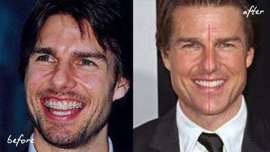 Tom Cruise Teeth: The Middle Tooth & Transformation