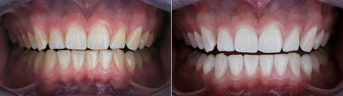 Teeth Whitening Strips Before and After