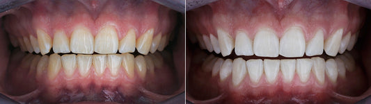 Teeth Whitening Strips Before and After
