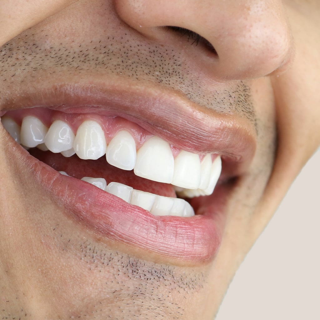 Non-Slip Teeth Whitening Strips (2 treatment trial pack)